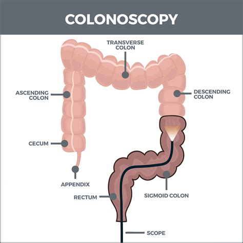 Colonoscopy Explained .